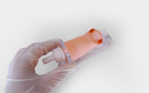 Dedo de Pie con Onicocriptosis