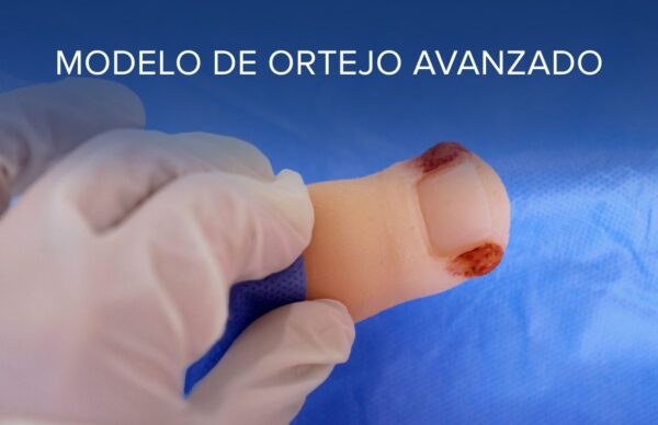 Dedo de Pie con Onicocriptosis