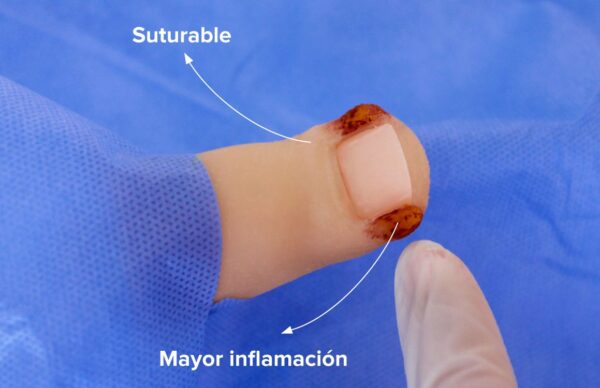 Dedo de Pie con Onicocriptosis