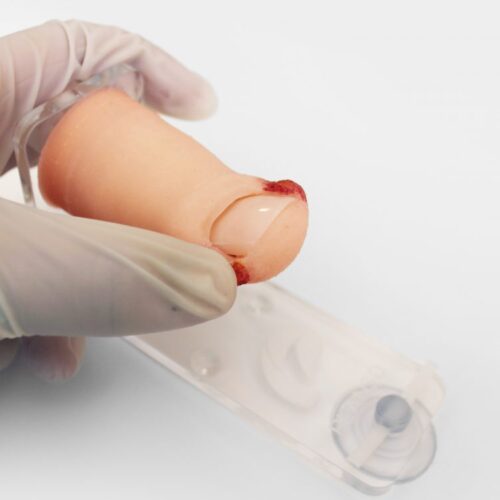 Dedo de Pie con Onicocriptosis