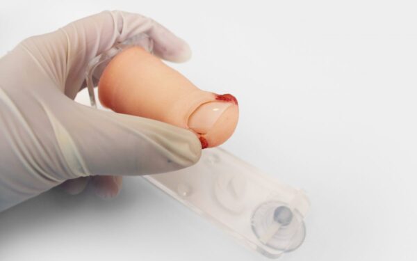 Dedo de Pie con Onicocriptosis