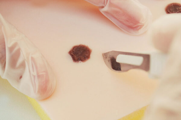 Piel de simulación con fibromas y lunares