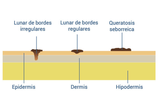 Piel de simulación con fibromas y lunares