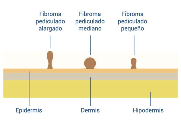 Piel de simulación con fibromas y lunares