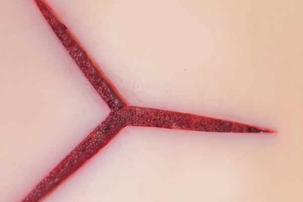 Piel avanzada con 1 herida