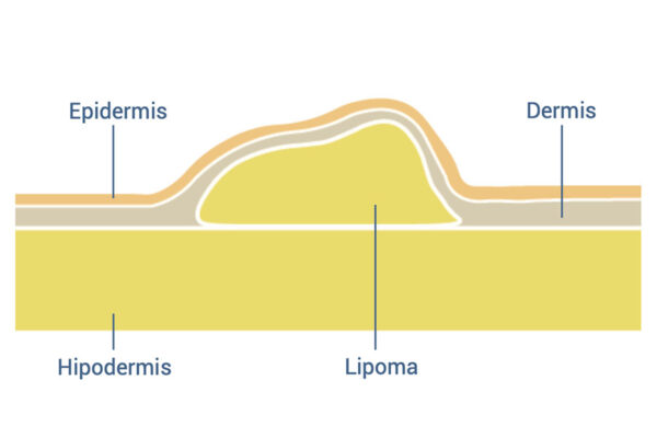 Piel de simulación de Lipomas