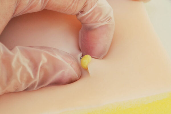 Piel de simulación con quistes sebáceos