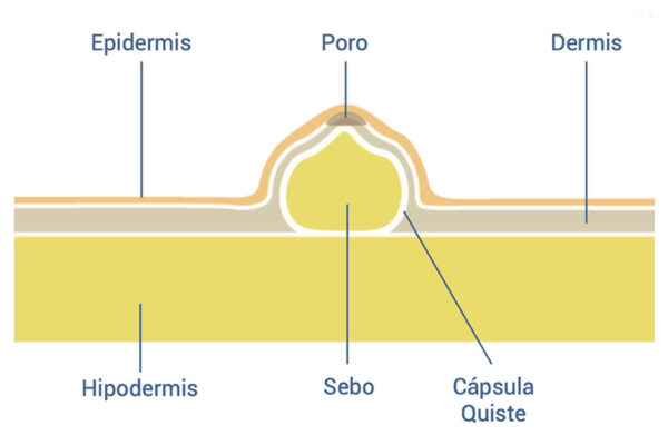 Piel de simulación con quistes sebáceos