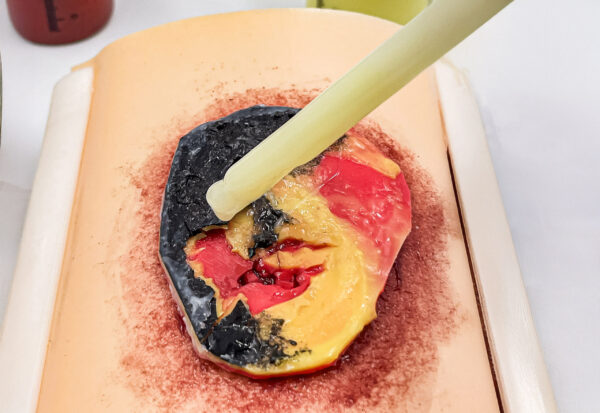 Úlcera por presión avanzada