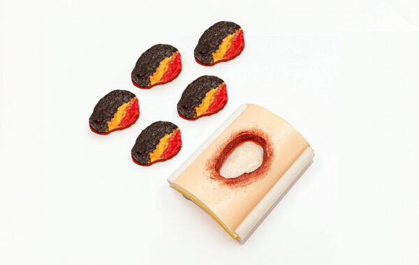 Úlcera por presión avanzada