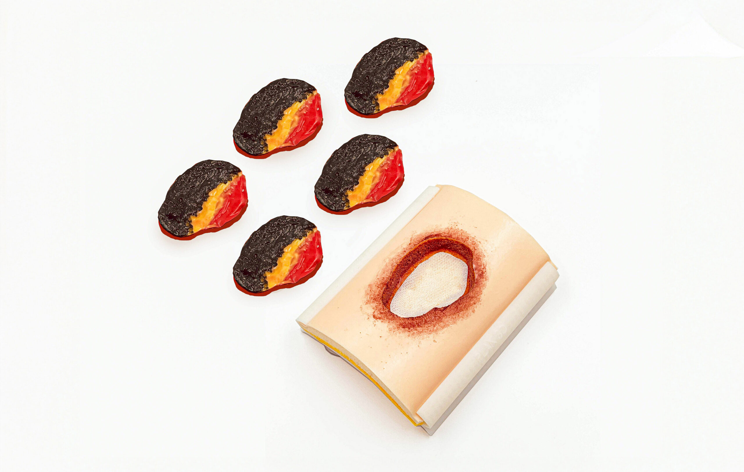 Úlcera por presión avanzada