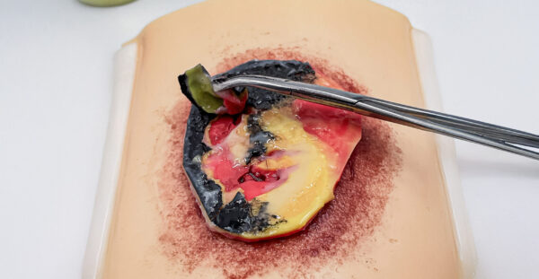 Úlcera por presión avanzada