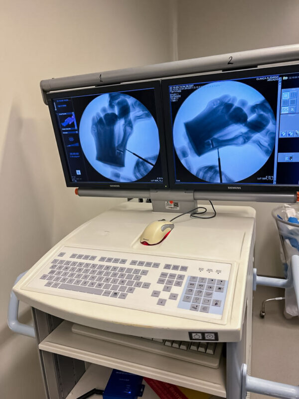 Pie con hallux valgus, huesos radiopacos