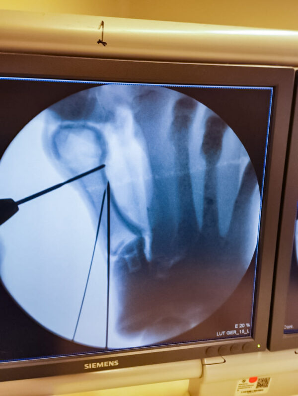 Pie con hallux valgus, huesos radiopacos