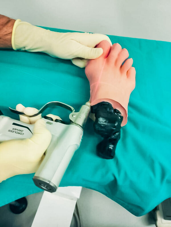 Pie con hallux valgus, huesos radiopacos