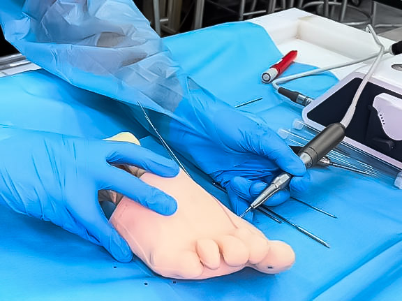 Pie con hallux valgus, huesos radiopacos
