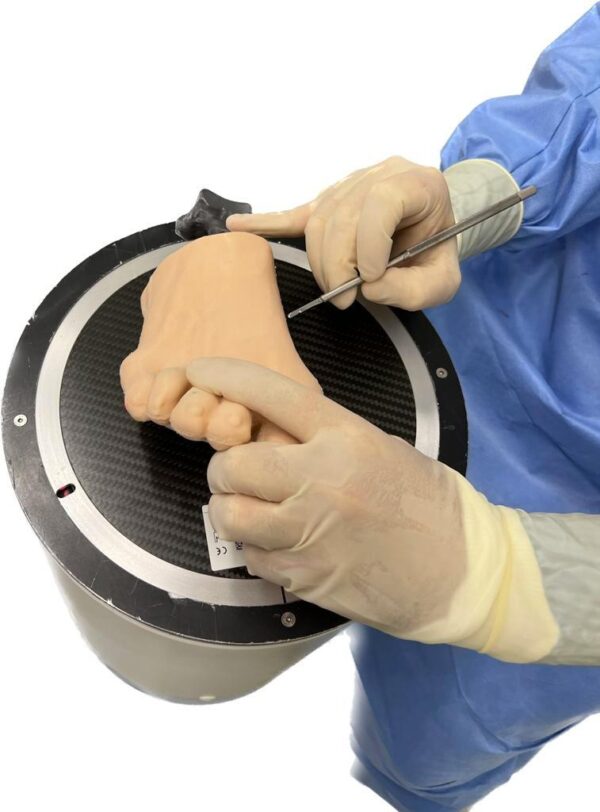 Pie con hallux valgus, huesos radiopacos