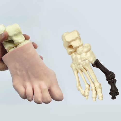 Pie con hallux valgus, huesos radiopacos