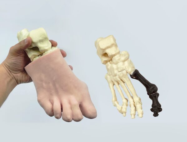 Pie con hallux valgus, huesos radiopacos