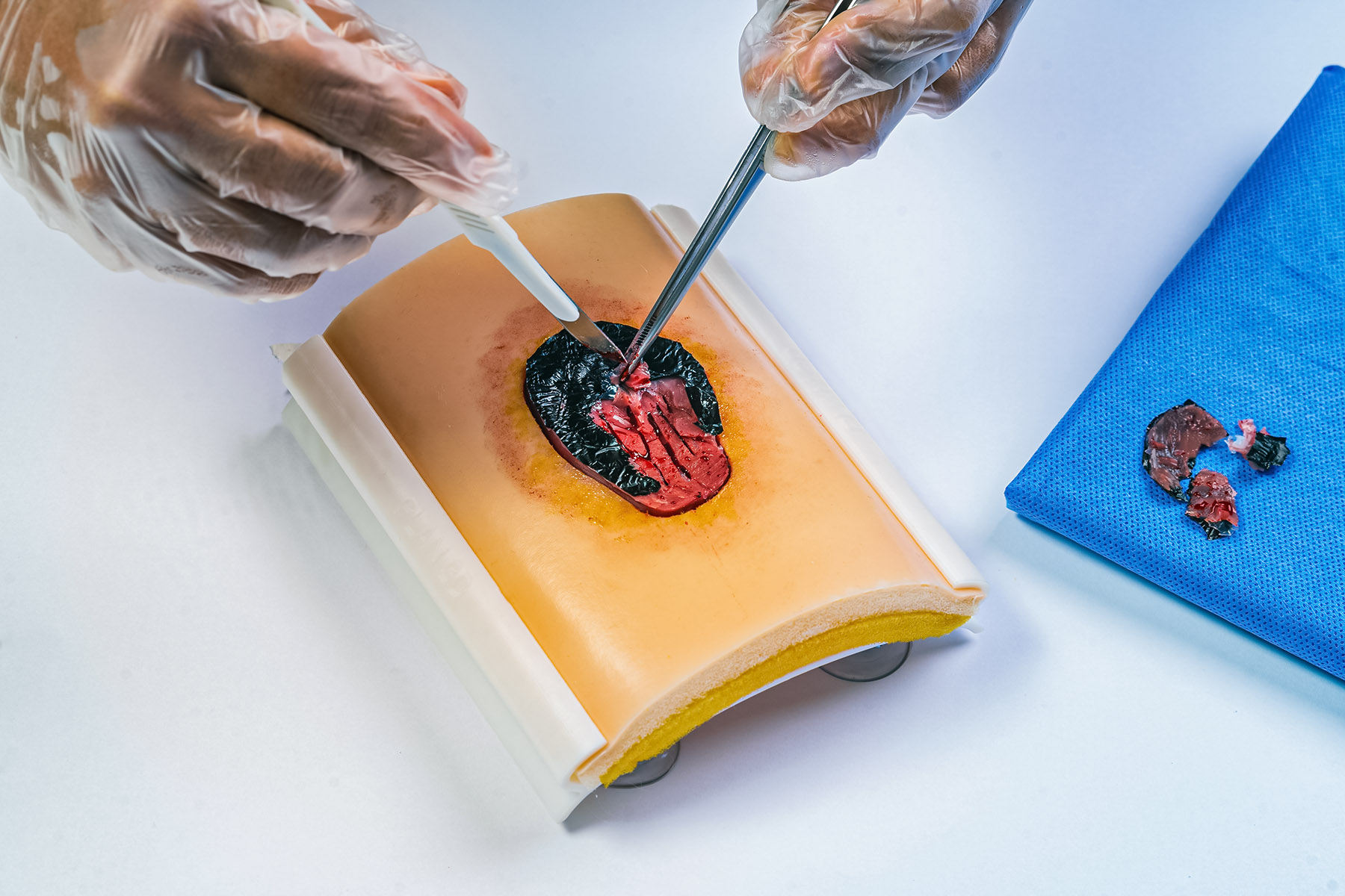 Ulcera-presion-01 Úlcera por presión