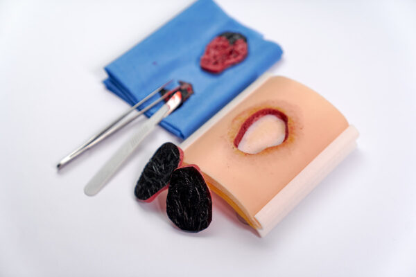 Ulcera-presion-04 Úlcera por presión