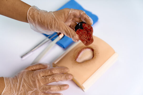 Ulcera-presion-05 Úlcera por presión