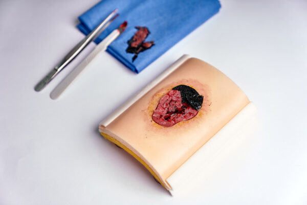 Ulcera-presion-06 Úlcera por presión