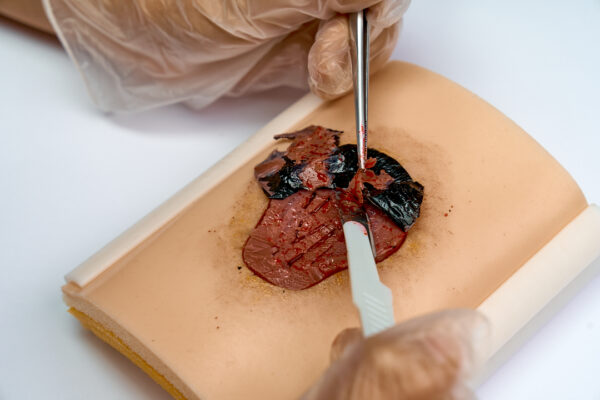 Ulcera-presion-07 Úlcera por presión