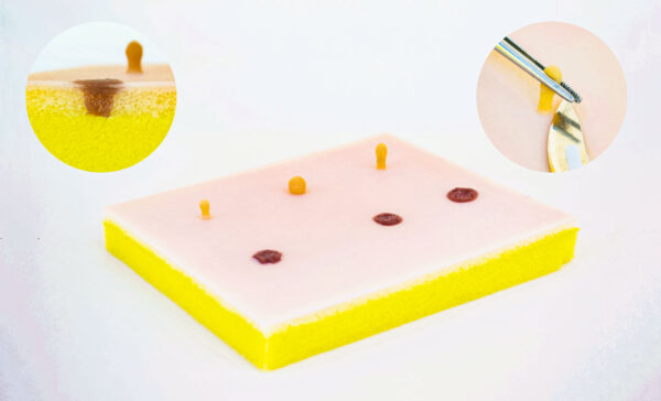 Piel con lipoma y quiste