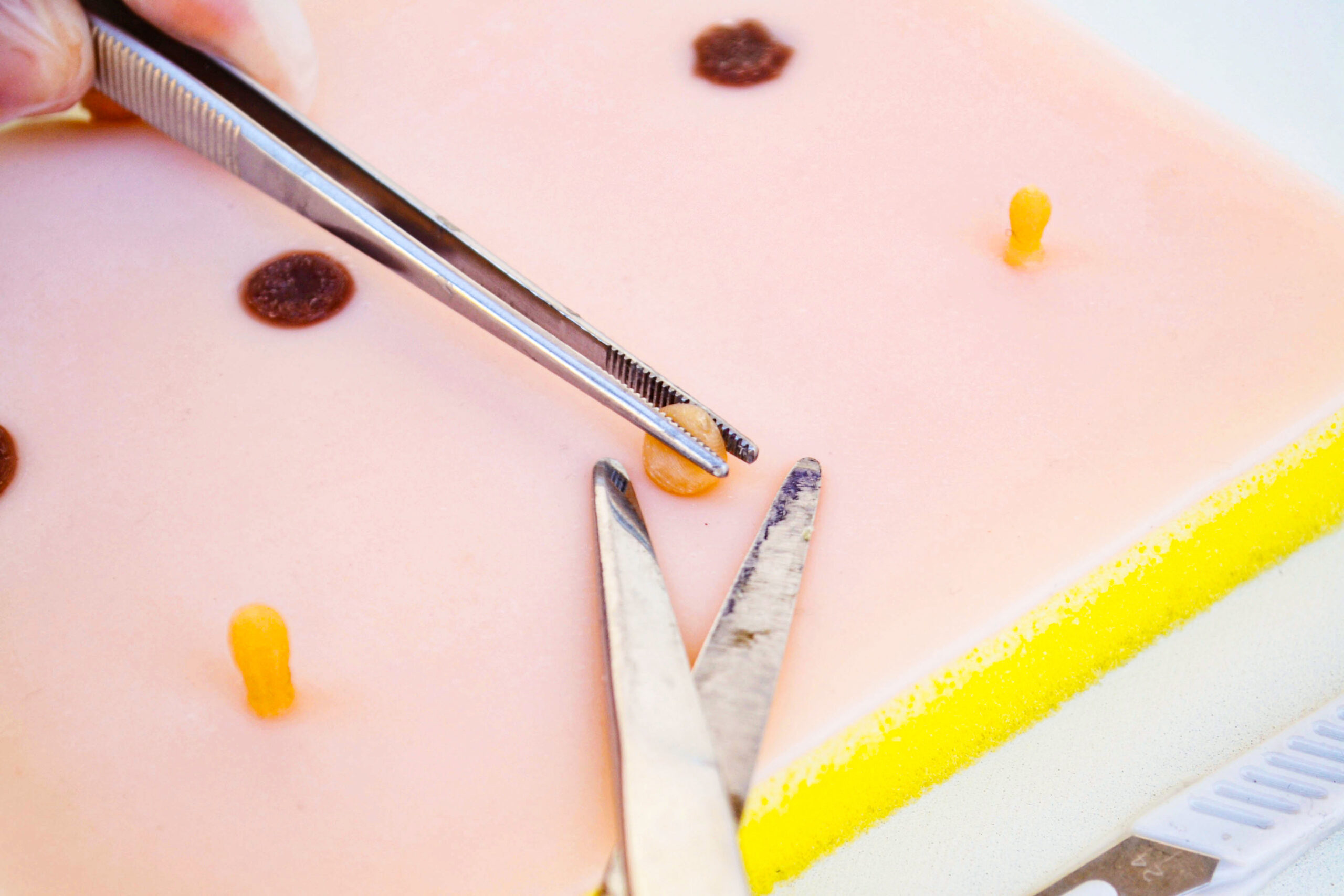 Piel con lipoma y quiste