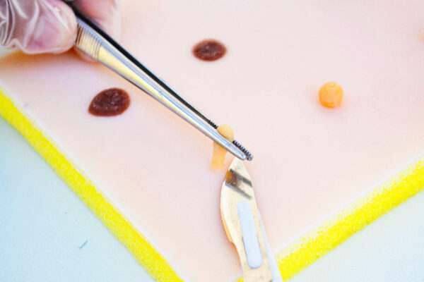 Piel con lipoma y quiste