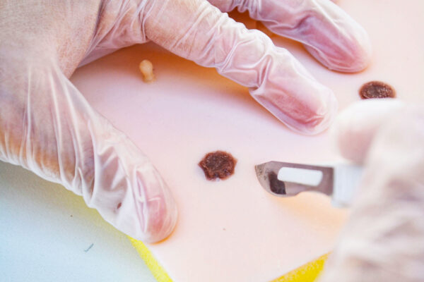 Piel con lipoma y quiste