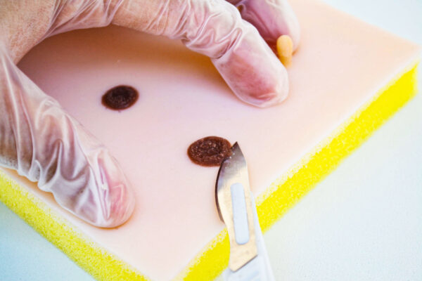 Piel con lipoma y quiste