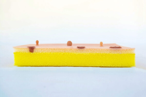 Piel con lipoma y quiste