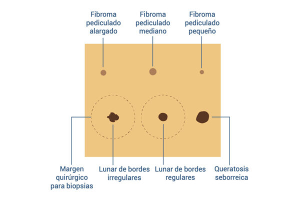 Piel con lipoma y quiste