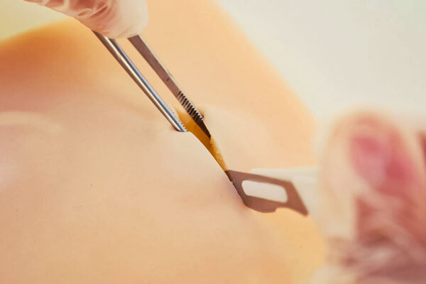 Piel con lipoma y quiste
