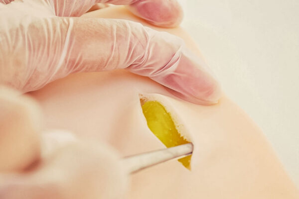 Piel con lipoma y quiste