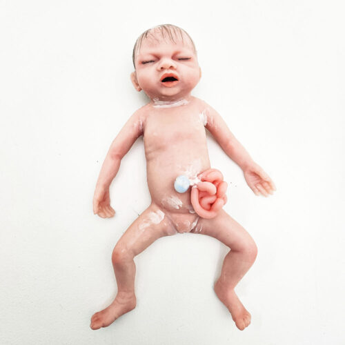 babylibby_gastro02 Baby Libby - Gastrosquisis